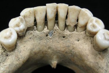 Denture with traces if lapis Lazuli