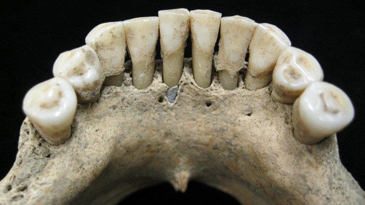 Dentadura postiza con trazas de lapislázuli